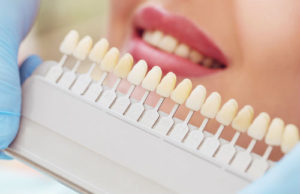 A woman with her teeth whitening tray on.