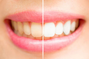 A woman 's teeth before and after whitening.