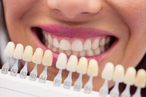 enamel veneers