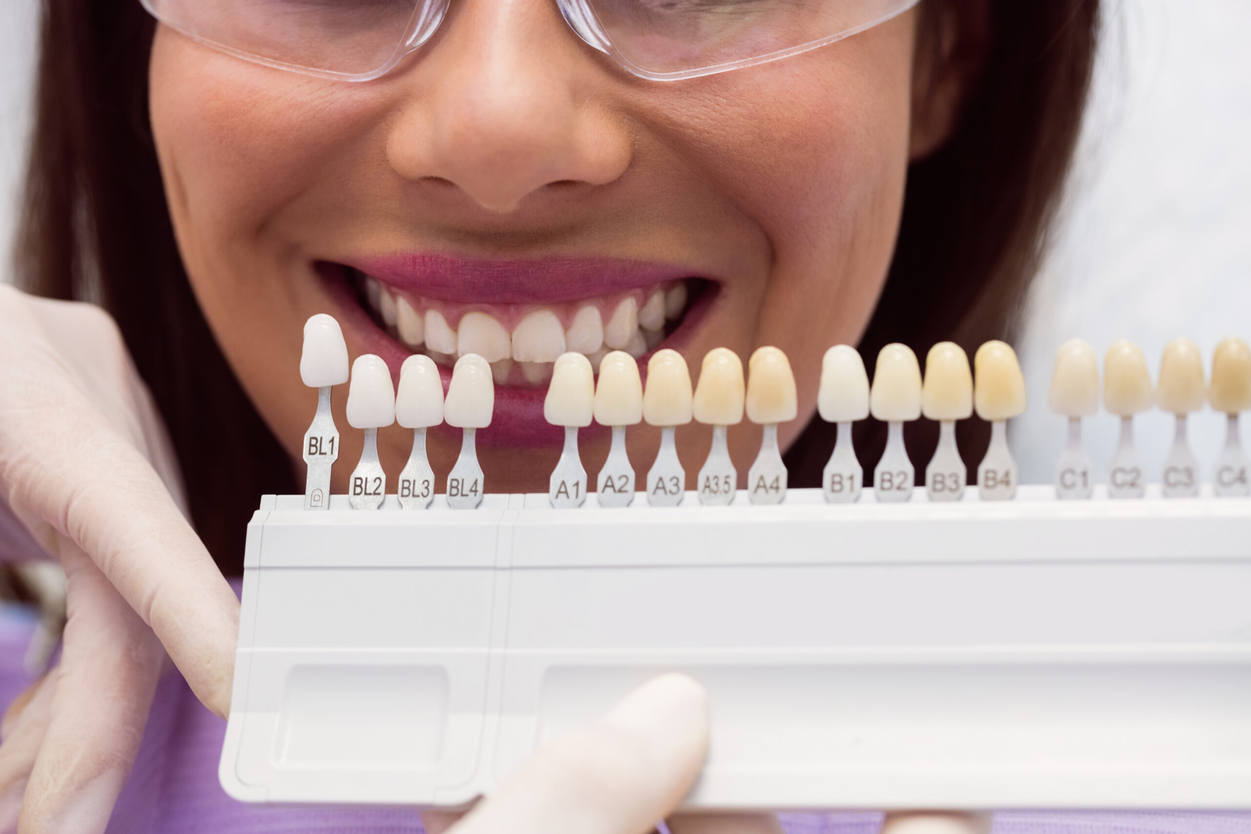 dental veneers for teeth